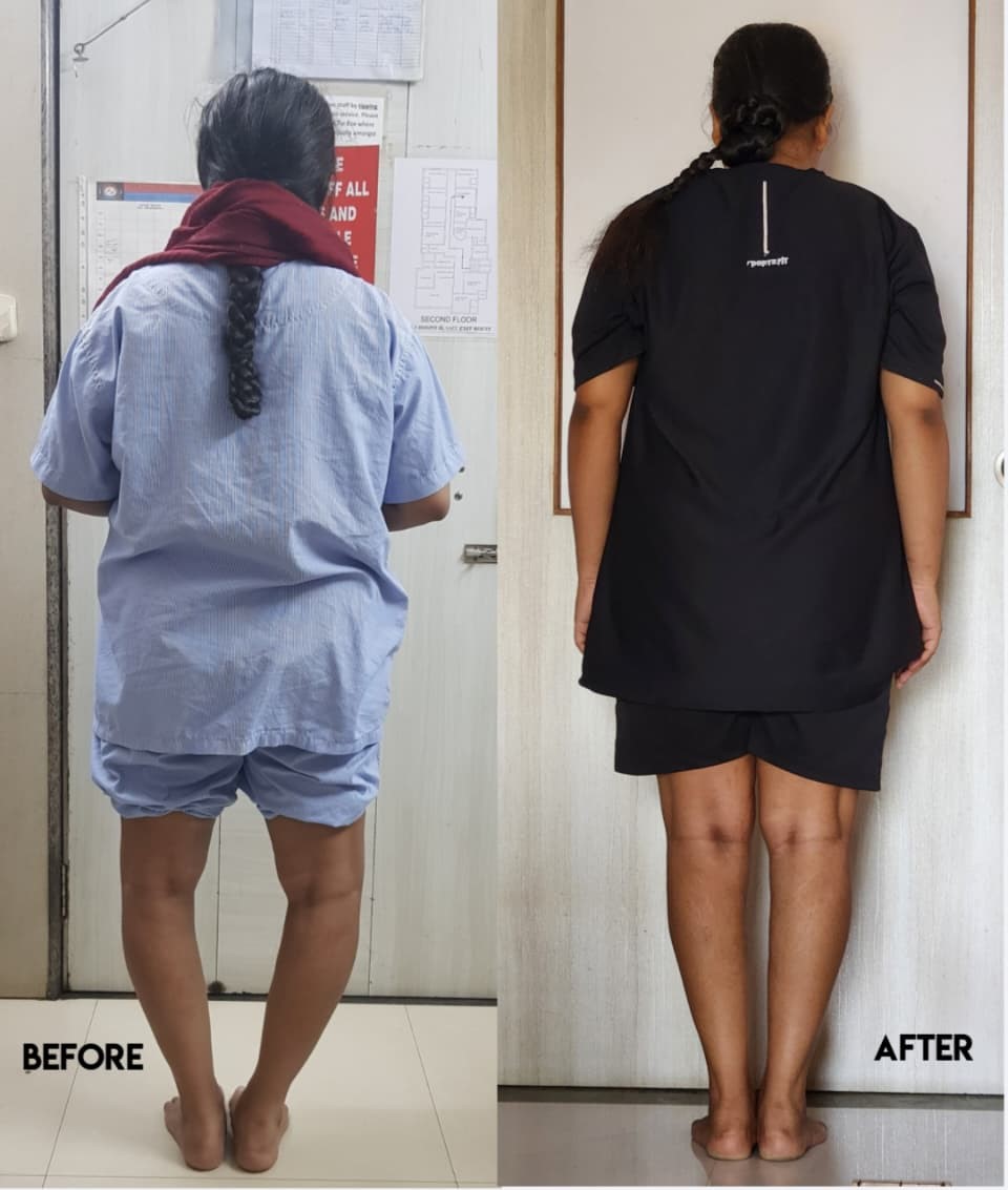 Bow leg Surgery Image