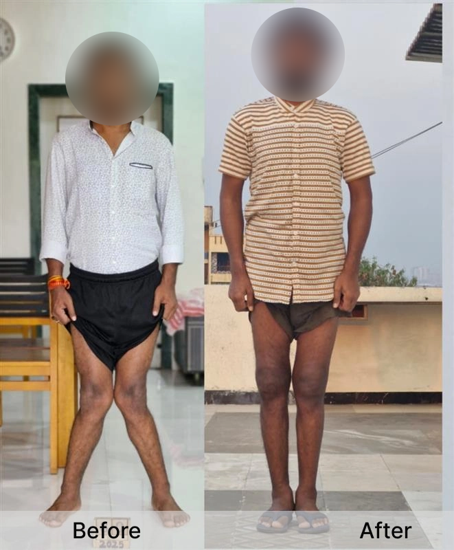 Knock Knee Surgery