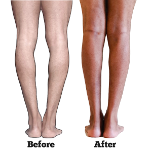 Bow Legs